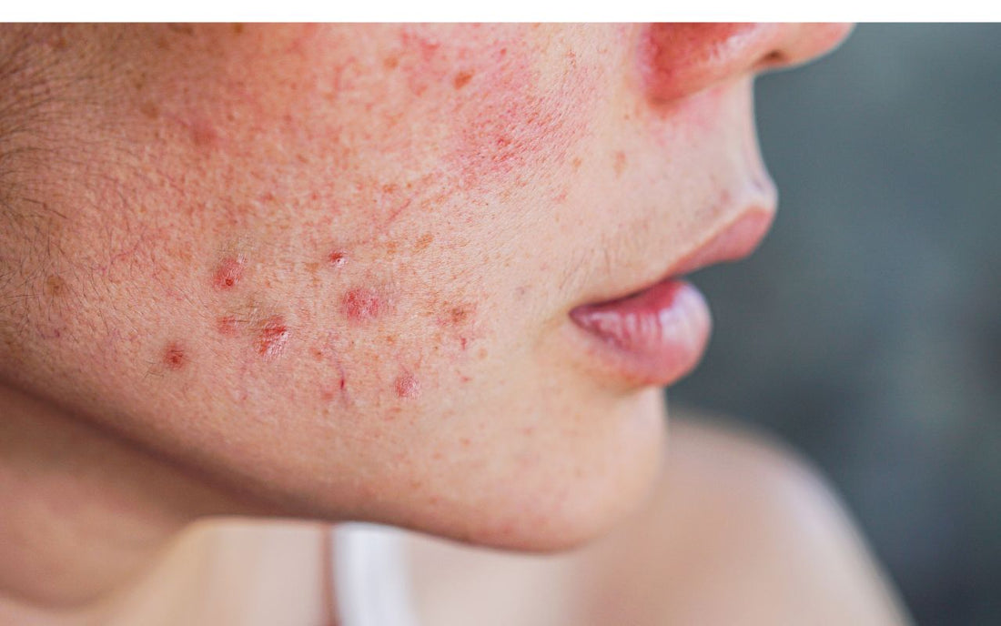 Acne-Prone Skin: The Ultimate Guide to Clearing and Calming Breakouts