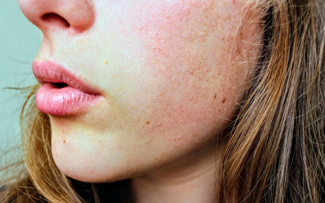 Skin Redness: The Ultimate Guide to Calming Irritated Skin