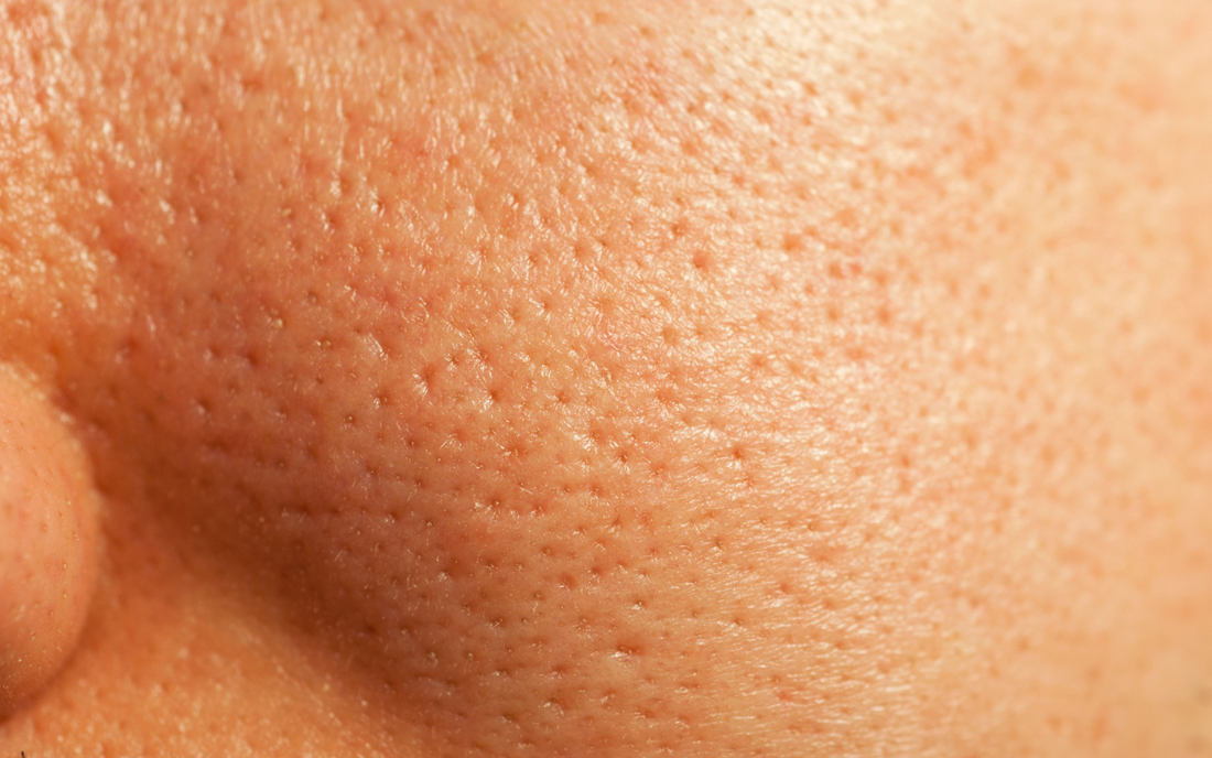 Sebum Pic What is Sebum? Is it Good or Bad for my Skin? – Mistia Shop